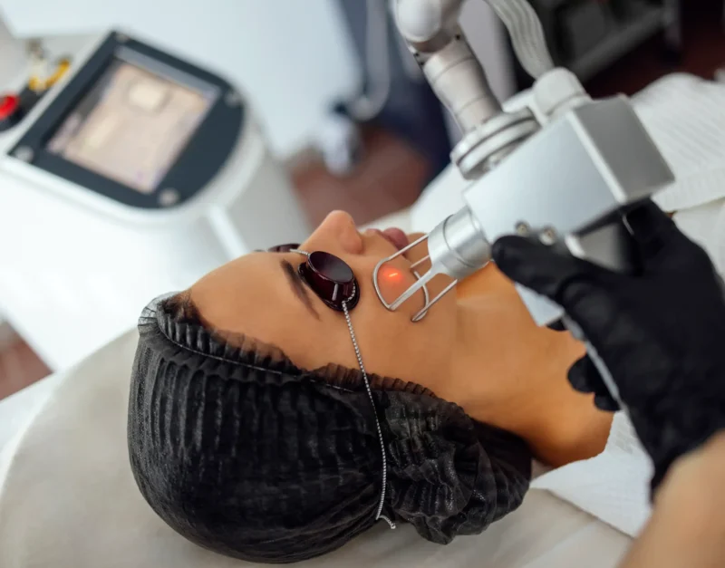 closeup-of-the-face-of-young-woman-undergoing-lase-2025-01-09-22-01-48-utc