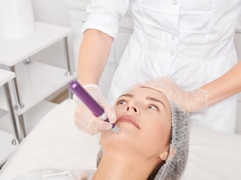 microneedling treatment