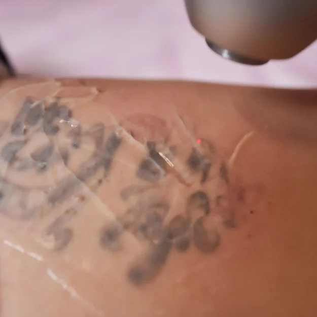 young-woman-undergoing-laser-tattoo-removal-procedure-salon-closeup