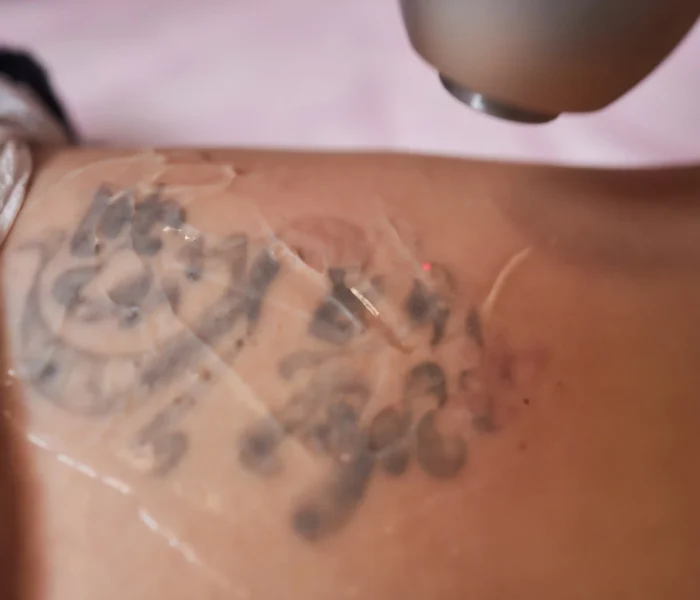 young-woman-undergoing-laser-tattoo-removal-procedure-salon-closeup