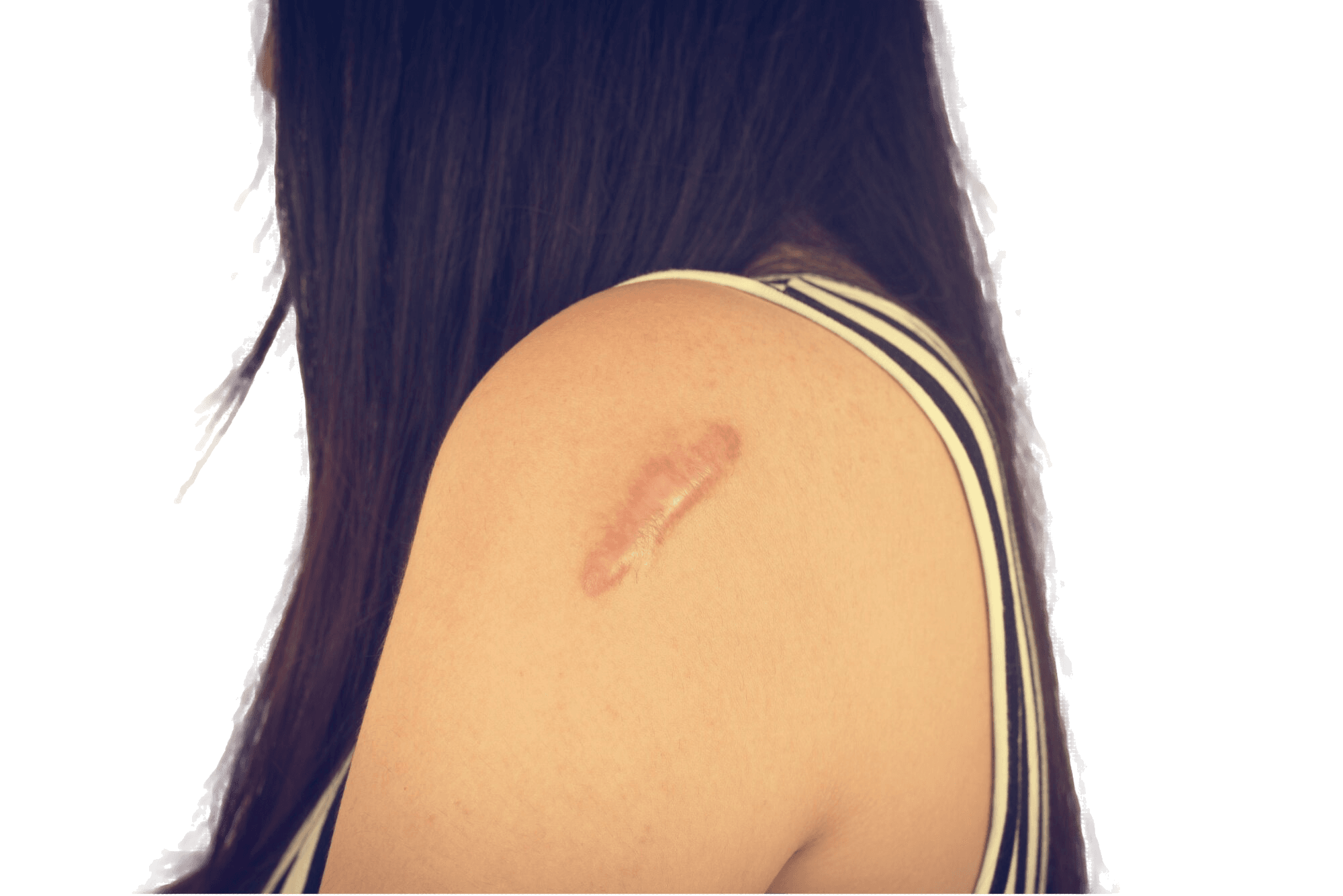 woman-with-scar-her-arm